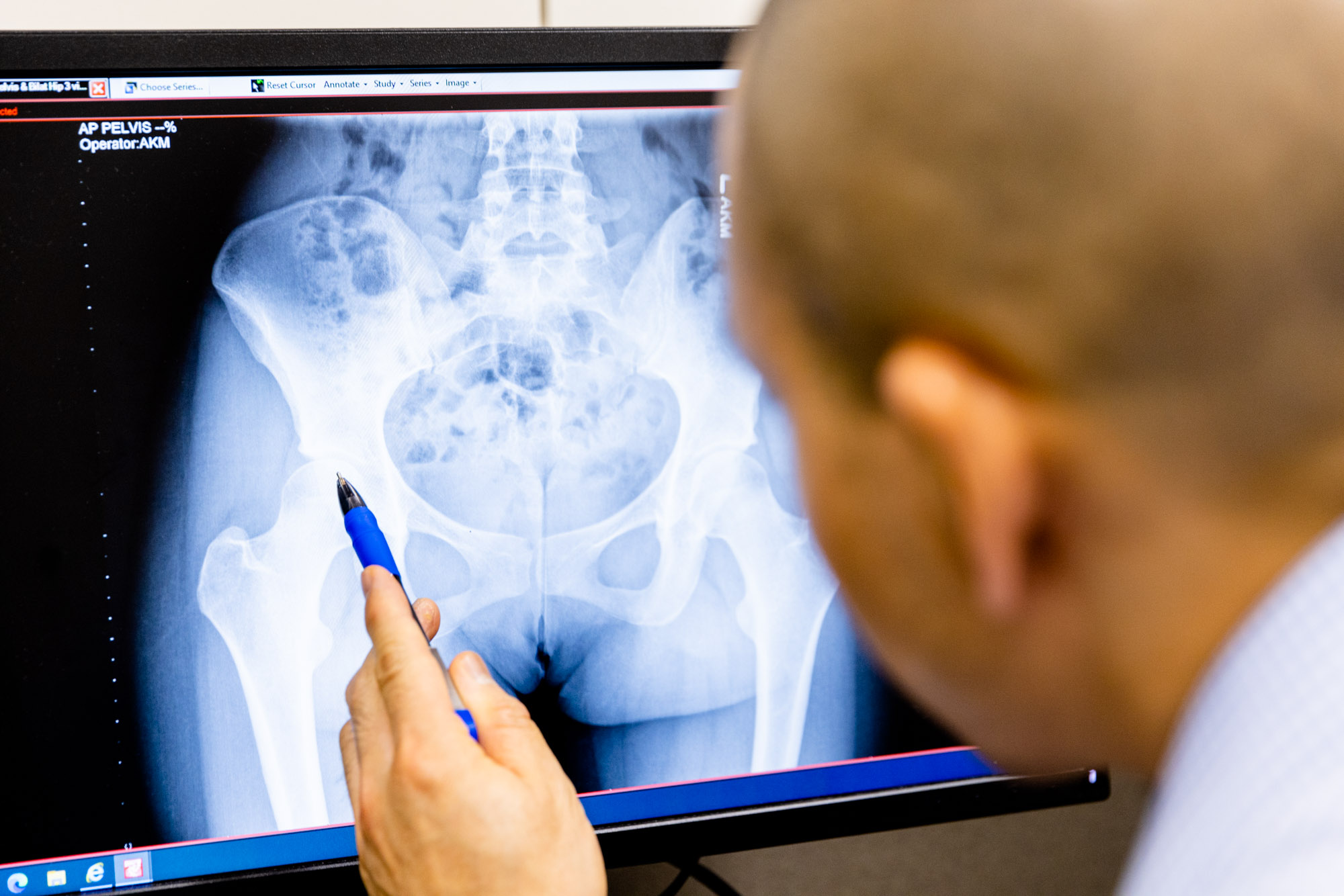 KCOA provider pointing to a hip X-ray to discuss hip arthroplasty in South KC.
